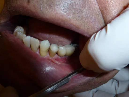Antybiotyki na zęby - Po jakim czasie antybiotyki na zęby zaczynają działać?