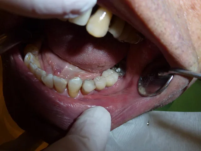 Gorączka po ekstrakcji zęba - przyczyny, objawy i leczenie